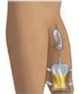 picture of a condom catheter on a male penis connected to tubing which is connected to a urine drainage bag on the thigh